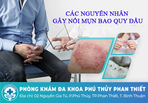 Mụn bao quy đầu ở nam giới cảnh giác với bệnh gì?